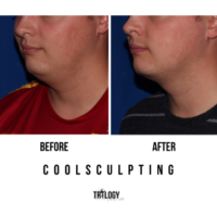 Coolsculpting Face Treatment Before and After Photos | Trilogy Medical Center | Murray, UT