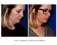 Coolsculpting Chin Treatment Before and After Photos | Trilogy Medical Center | Murray, UT