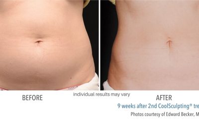 Coolsculpting Before and After Treatment Photos | Trilogy Medical Center in Murray, UT