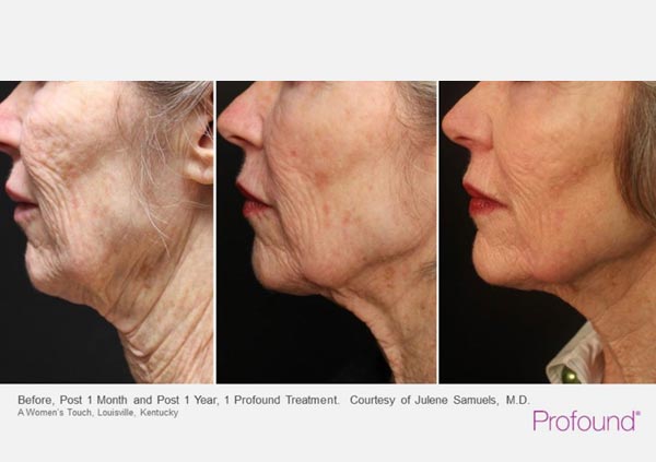 Profound Skin Tightening Treatment Before and After Treatment Photos | Trilogy Medical Center in Murray, UT