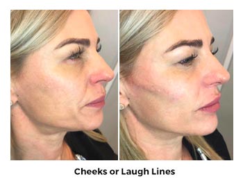 Cheeks Or Laugh Lines Treatment Before and After Photos | Trilogy Medical Center | Murray, UT