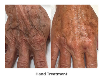 Hand Treatment Before and After Photos | Trilogy Medical Center | Murray, UT