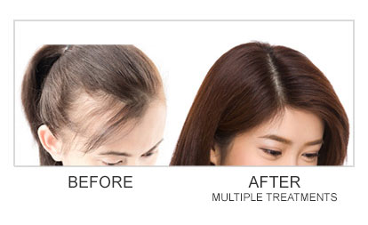 Natural Growth Factor Injections Hair Loss Treatment Before and After Photos | Trilogy Medical Center | Murray, UT