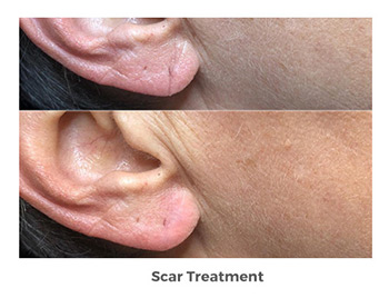 Scar Treatment Before and After Photos | Trilogy Medical Center | Murray, UT