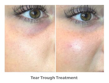 Tear Trough Treatment Before and After Photos | Trilogy Medical Center | Murray, UT
