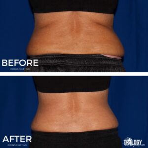Coolsculpting Before and After (2)