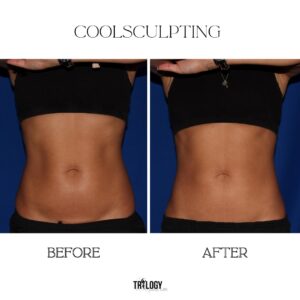 Coolsculpting Before and After (4)