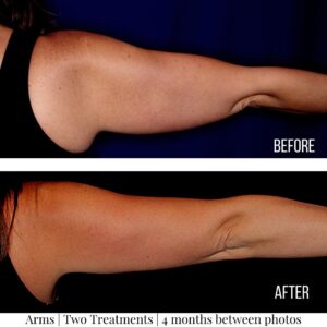 Coolsculpting Before and After (5)