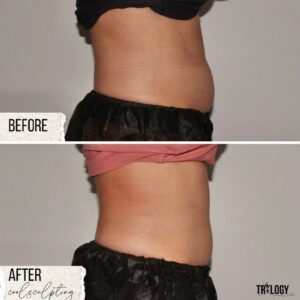 Coolsculpting Before and After (6)