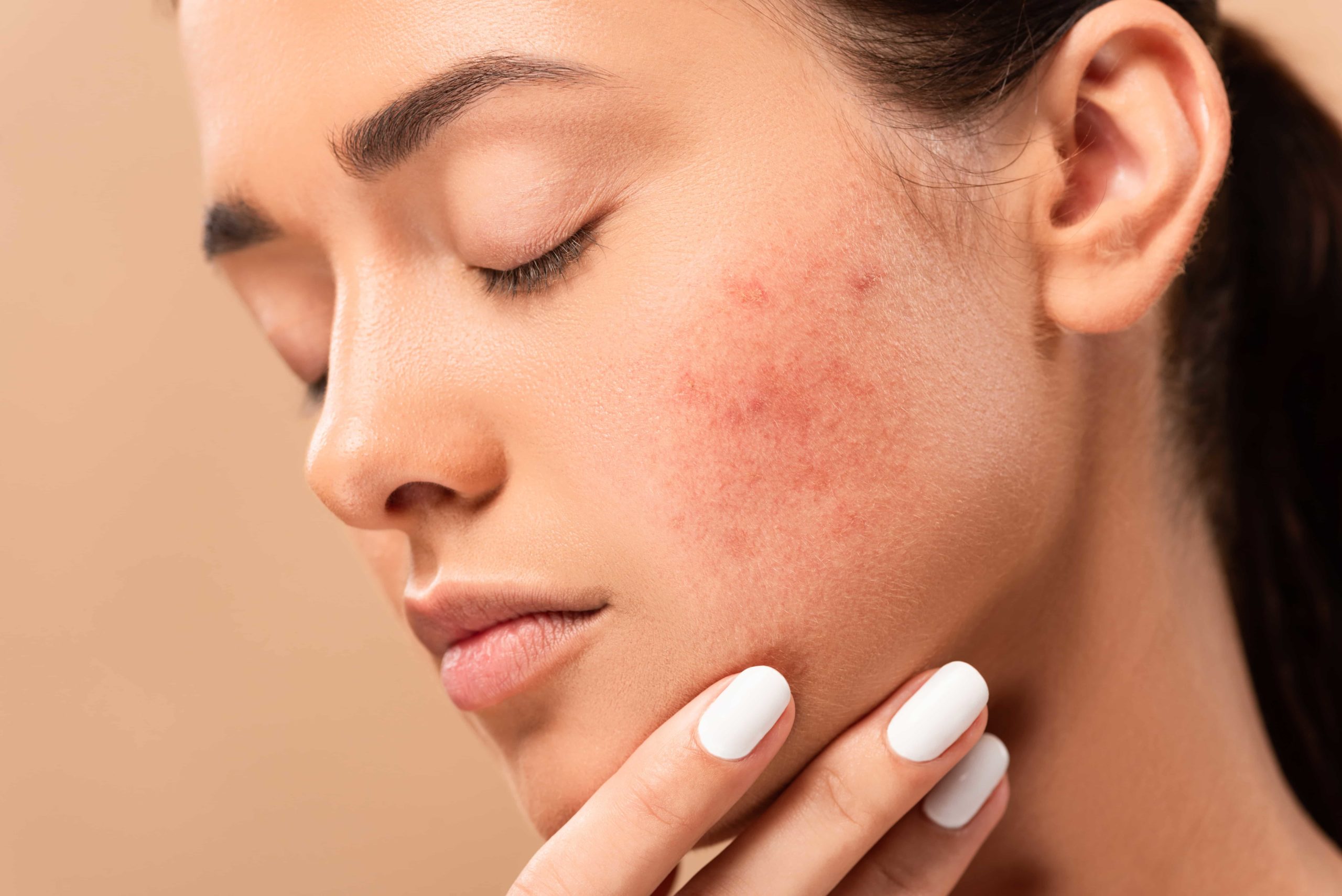 What Are Some Acne Treatments To Avoid