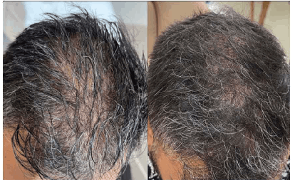 trilogymedicalcenter-natural-growth-factor-injections-hair-loss-before-and-after (1)
