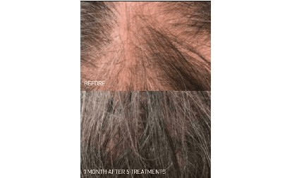 trilogymedicalcenter-natural-growth-factor-injections-hair-loss-before-and-after (2)