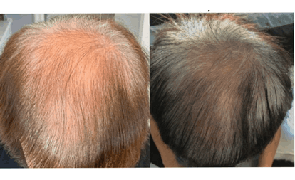 trilogymedicalcenter-natural-growth-factor-injections-hair-loss-before-and-after