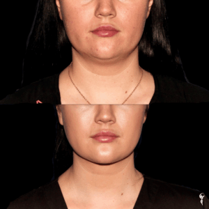 Copy of Coolsculpting anniversary (1)