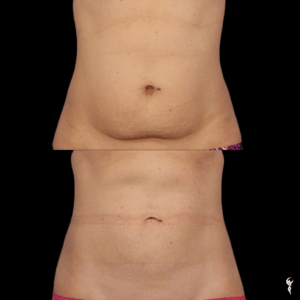 Copy of Coolsculpting anniversary (2)