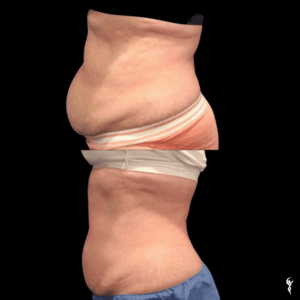 Copy of Coolsculpting anniversary (4)