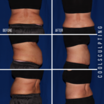 Coolsculpting Treatment Before and After Photos | Trilogy Medical Center | Murray, UT
